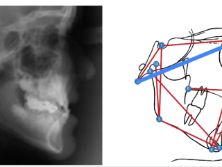 x-ray of a head skeleton and a diagram of a head skeleton