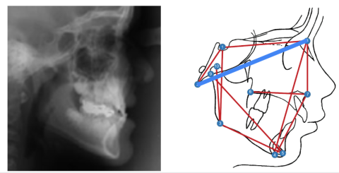 x-ray of a head skeleton and a diagram of a head skeleton